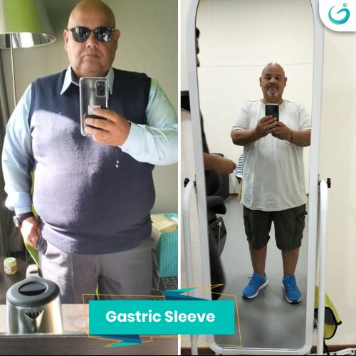 Gastric Sleeve Before / After photo
